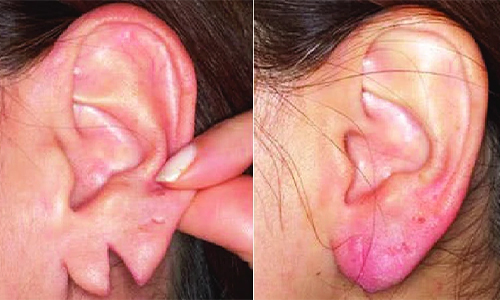 Ear Lobe Repair