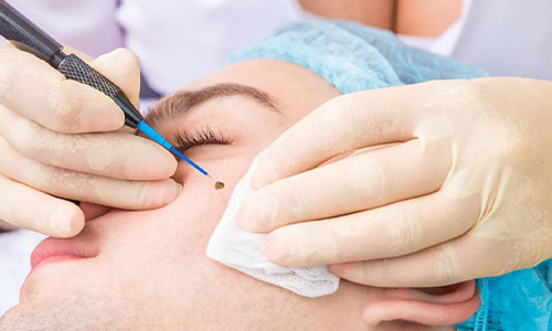 Mole and Skin Tag Removal