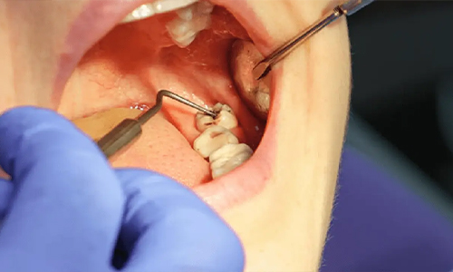 Wisdom Tooth Surgery